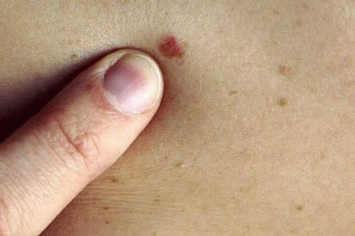 como identificar el cancer de la piel